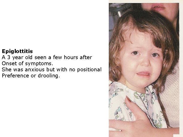 Epiglottitis A 3 year old seen a few hours after Onset of symptoms. She