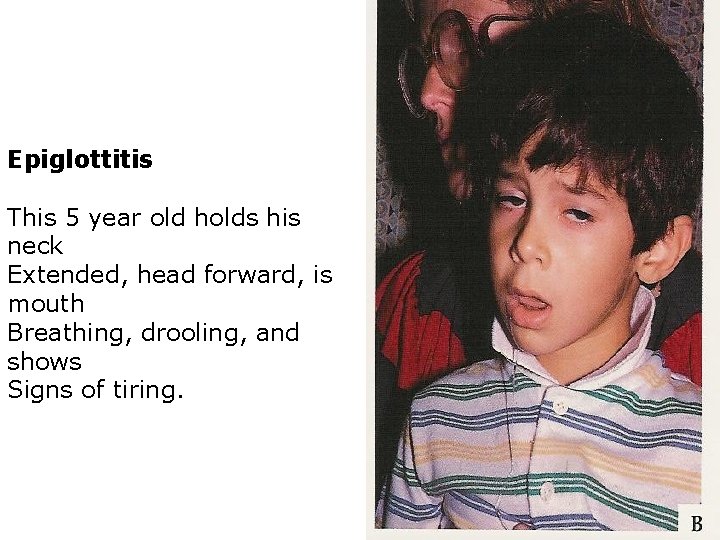Epiglottitis This 5 year old holds his neck Extended, head forward, is mouth Breathing,