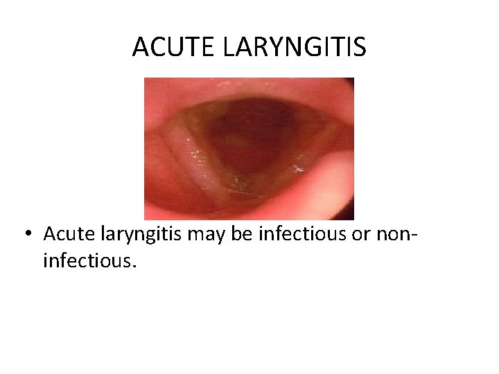 ACUTE LARYNGITIS • Acute laryngitis may be infectious or noninfectious. 