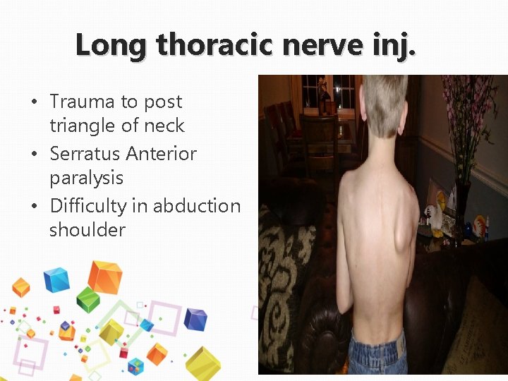 Long thoracic nerve inj. • Trauma to post triangle of neck • Serratus Anterior