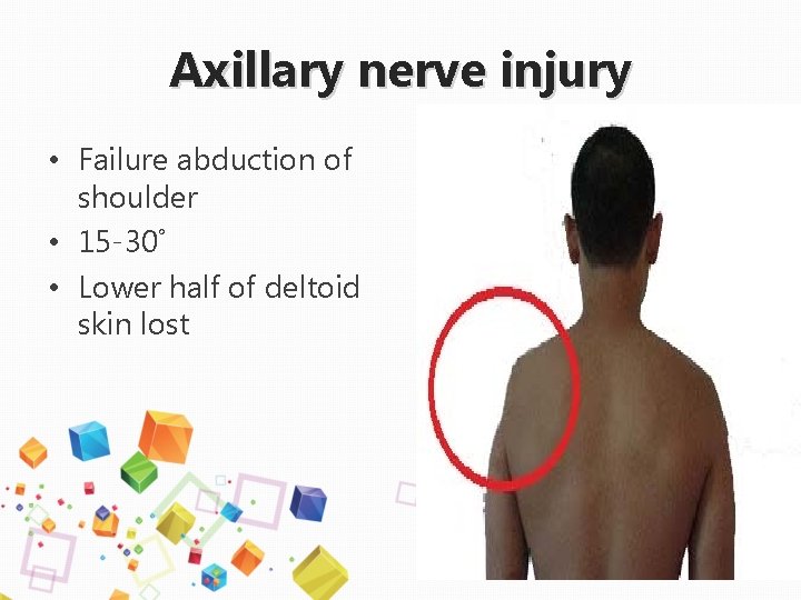 Axillary nerve injury • Failure abduction of shoulder • 15 -30˚ • Lower half