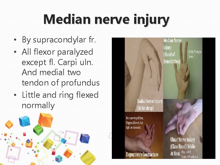 Median nerve injury • By supracondylar fr. • All flexor paralyzed except fl. Carpi