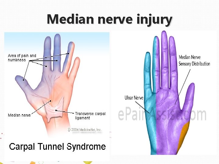 Median nerve injury 