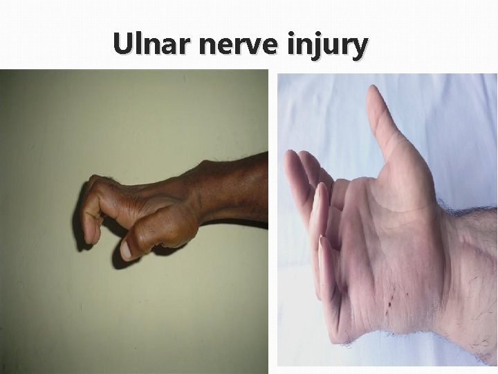 Cutaneous nerve Nerve injury of the upper limb