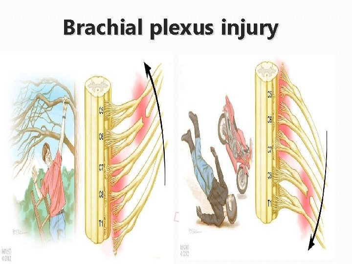 Brachial plexus injury 
