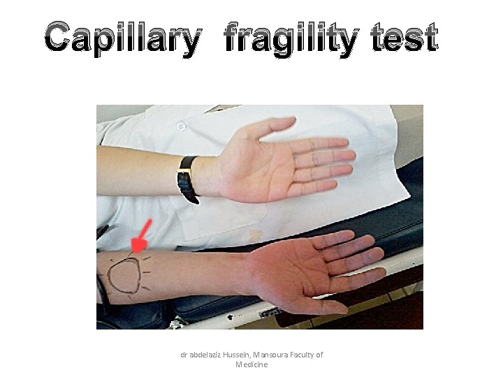 Capillary fragility test dr abdelaziz Hussein, Mansoura Faculty of Medicine 