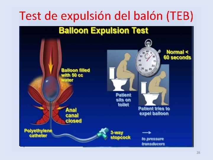 Test de expulsión del balón (TEB) 28 