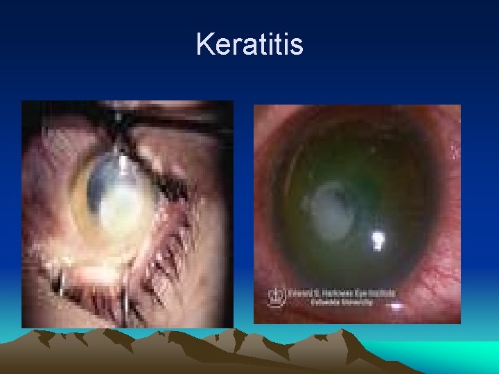 Keratitis 