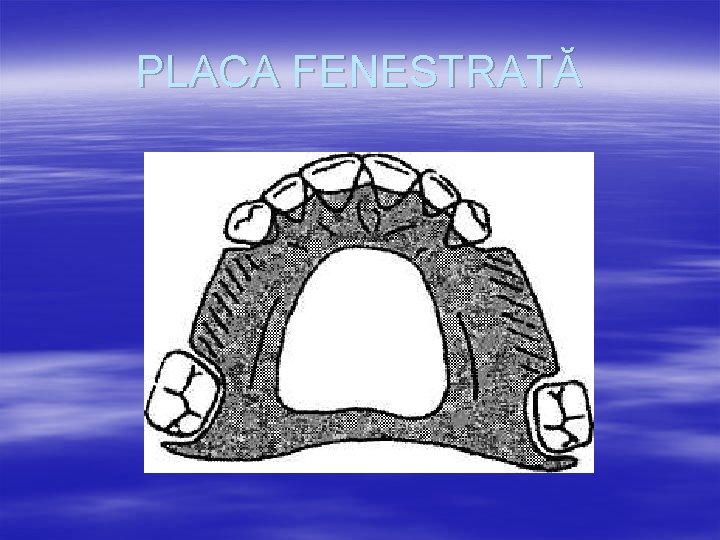 PLACA FENESTRATĂ 