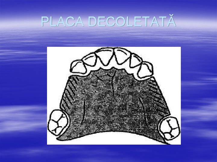 PLACA DECOLETATĂ 