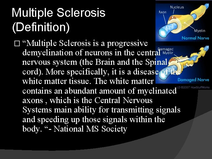 Multiple Sclerosis (Definition) � “Multiple Sclerosis is a progressive demyelination of neurons in the