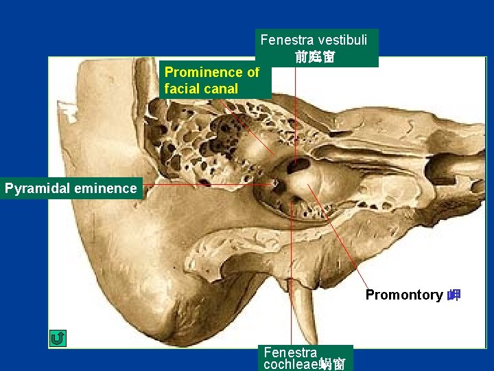 Fenestra vestibuli 前庭窗 Prominence of facial canal Pyramidal eminence Promontory 岬 Fenestra cochleae蜗窗 