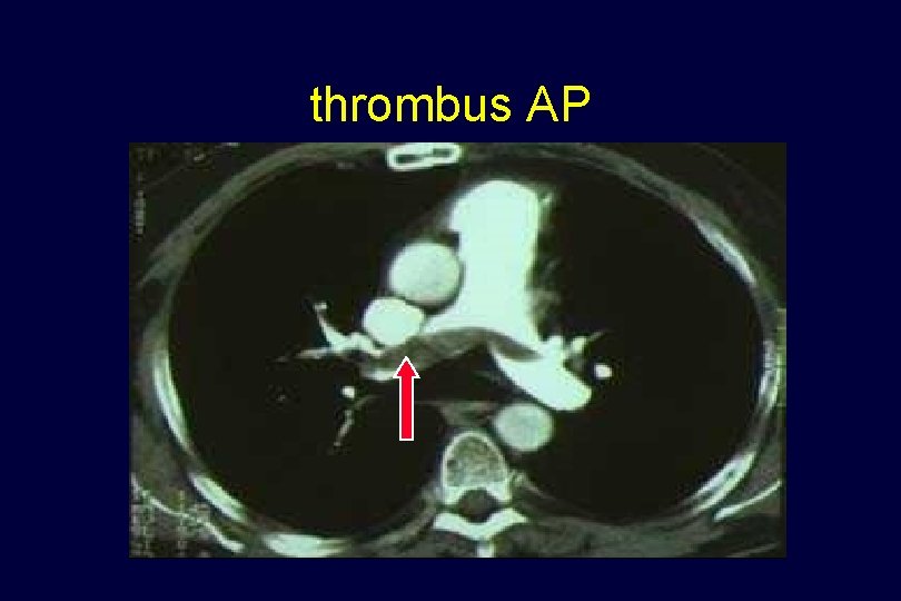 thrombus AP 