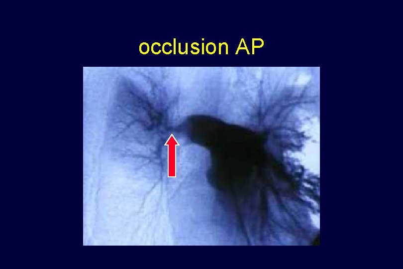 occlusion AP 