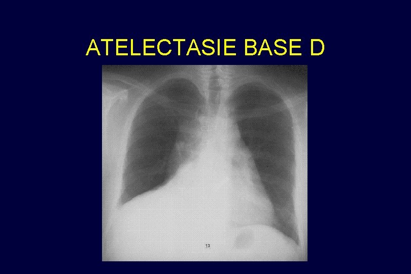 ATELECTASIE BASE D 