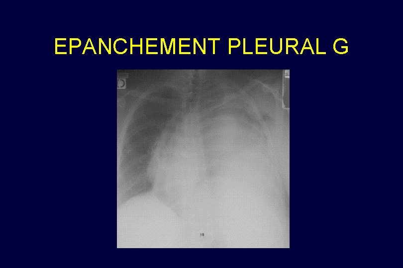 EPANCHEMENT PLEURAL G 