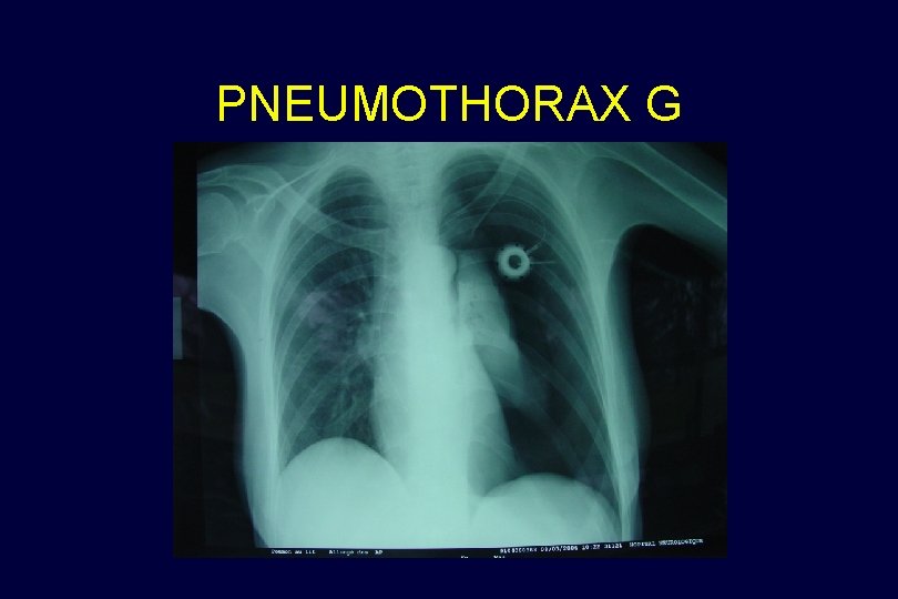 PNEUMOTHORAX G 