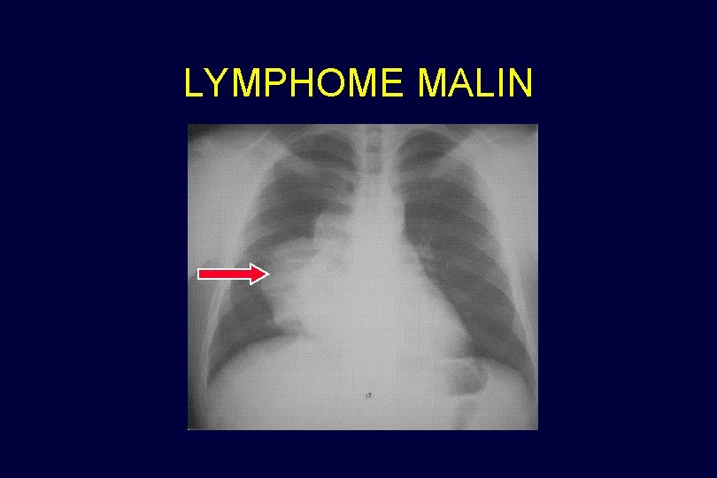 LYMPHOME MALIN 