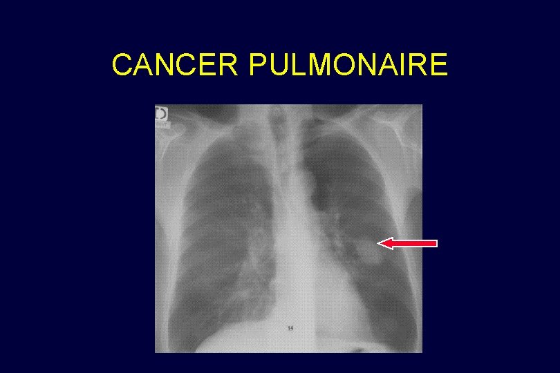 CANCER PULMONAIRE 