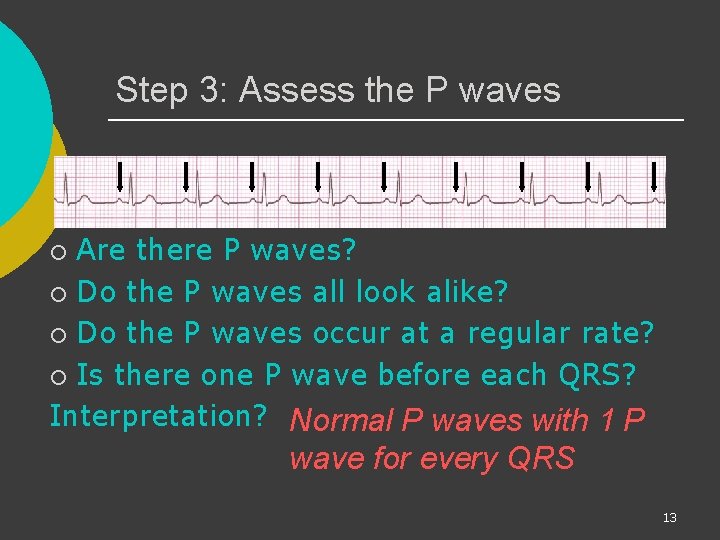 Step 3: Assess the P waves Are there P waves? ¡ Do the P