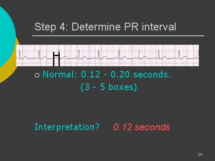 Step 4: Determine PR interval ¡ Normal: 0. 12 - 0. 20 seconds. (3
