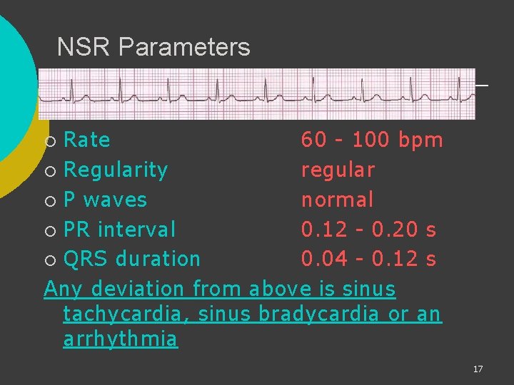 NSR Parameters Rate 60 - 100 bpm ¡ Regularity regular ¡ P waves normal