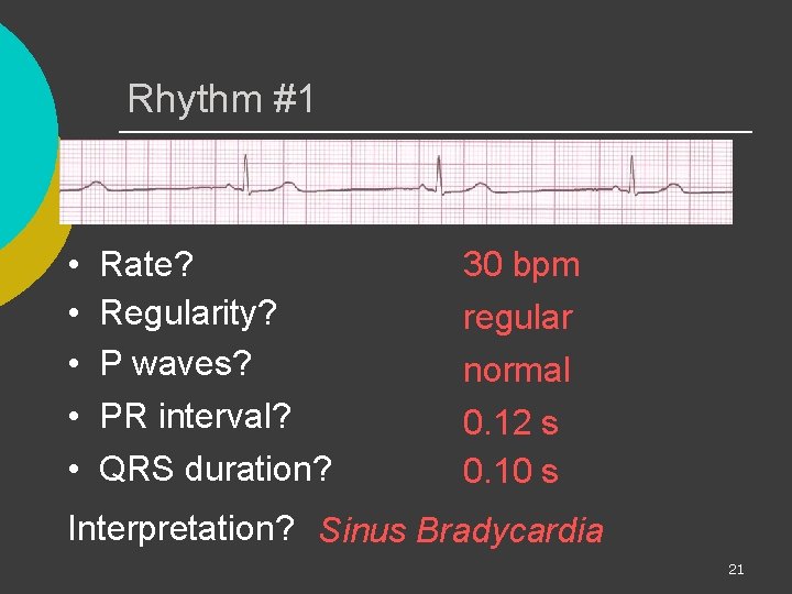 Rhythm #1 • • • Rate? Regularity? P waves? PR interval? QRS duration? 30