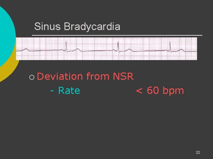 Sinus Bradycardia ¡ Deviation - Rate from NSR < 60 bpm 22 