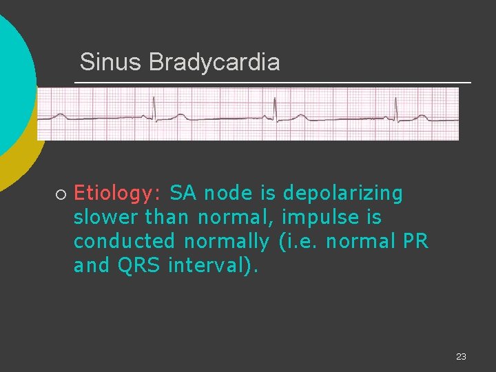 Sinus Bradycardia ¡ Etiology: SA node is depolarizing slower than normal, impulse is conducted