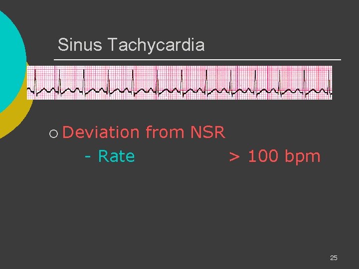 Sinus Tachycardia ¡ Deviation - Rate from NSR > 100 bpm 25 