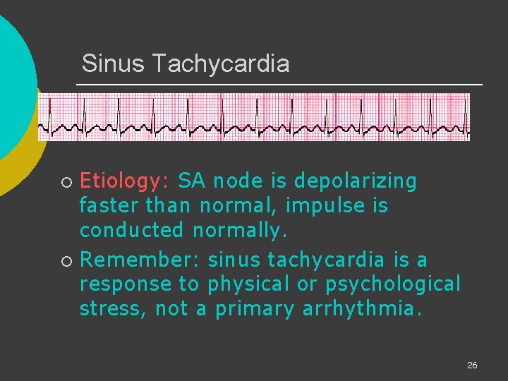Sinus Tachycardia Etiology: SA node is depolarizing faster than normal, impulse is conducted normally.