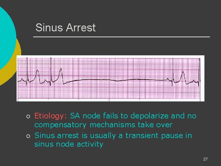 Sinus Arrest ¡ ¡ Etiology: SA node fails to depolarize and no compensatory mechanisms