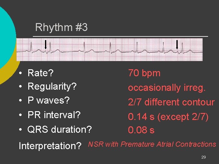 Rhythm #3 • • • Rate? Regularity? P waves? PR interval? QRS duration? Interpretation?