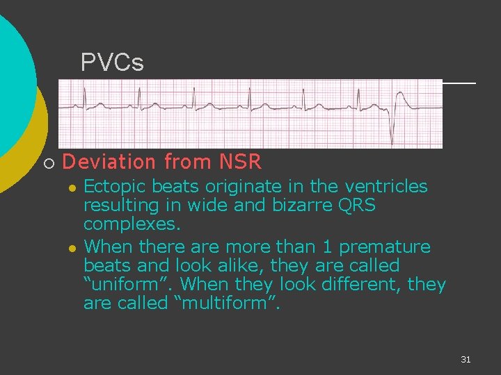 PVCs ¡ Deviation from NSR l l Ectopic beats originate in the ventricles resulting