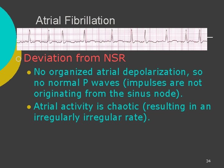 Atrial Fibrillation ¡ Deviation from NSR No organized atrial depolarization, so no normal P