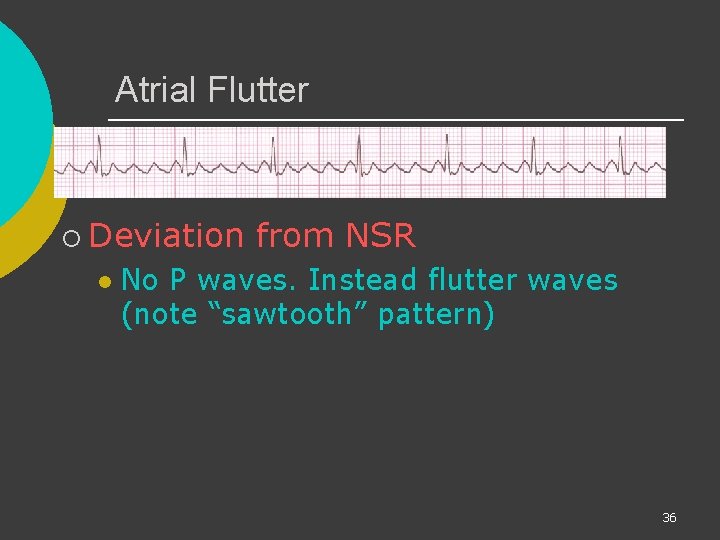 Atrial Flutter ¡ Deviation l from NSR No P waves. Instead flutter waves (note