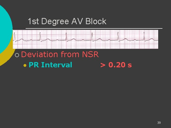1 st Degree AV Block ¡ Deviation l from NSR PR Interval > 0.