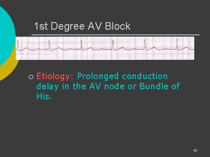 1 st Degree AV Block ¡ Etiology: Prolonged conduction delay in the AV node