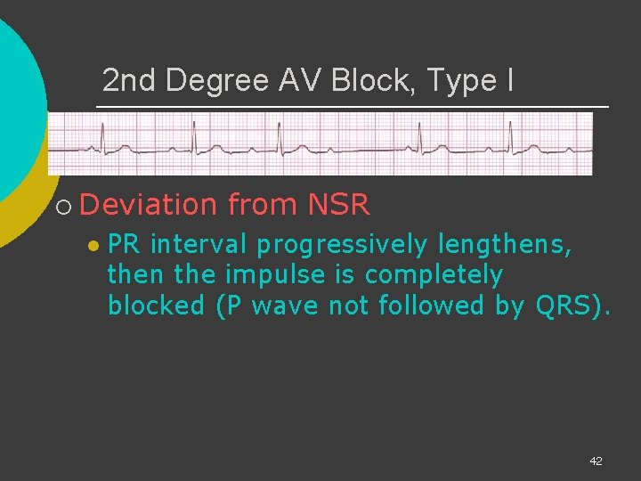 2 nd Degree AV Block, Type I ¡ Deviation l from NSR PR interval
