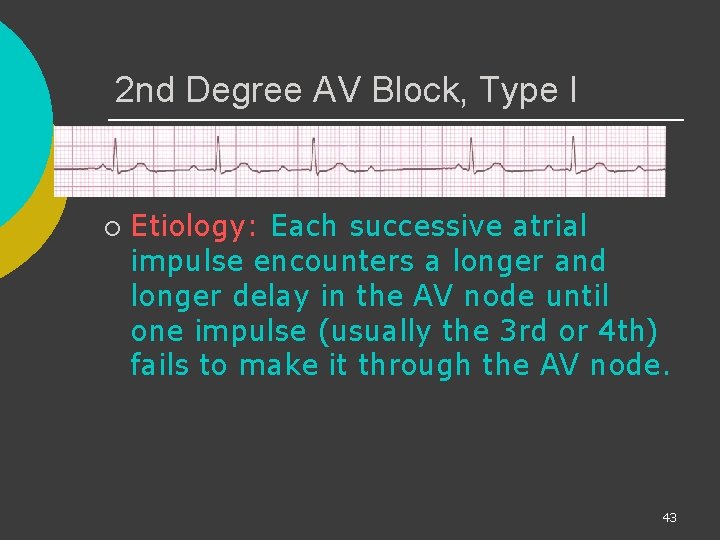 2 nd Degree AV Block, Type I ¡ Etiology: Each successive atrial impulse encounters