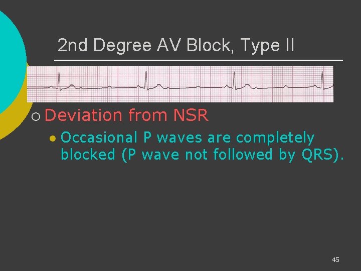 2 nd Degree AV Block, Type II ¡ Deviation l from NSR Occasional P