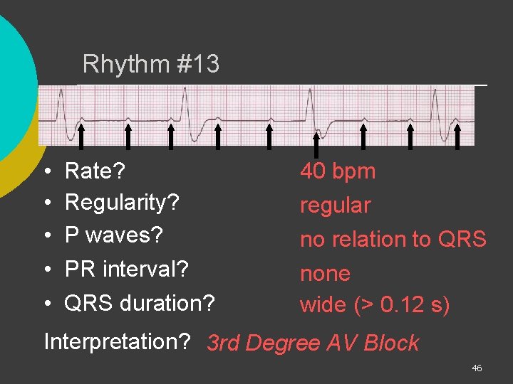 Rhythm #13 • • • Rate? Regularity? P waves? PR interval? QRS duration? 40