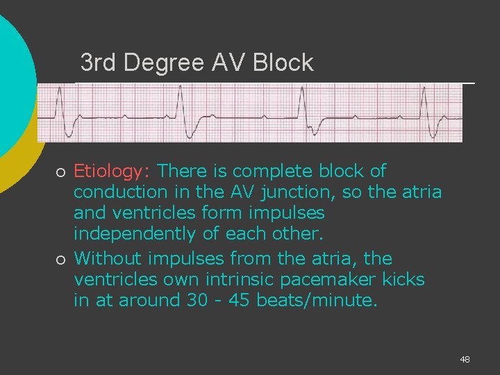 3 rd Degree AV Block ¡ ¡ Etiology: There is complete block of conduction