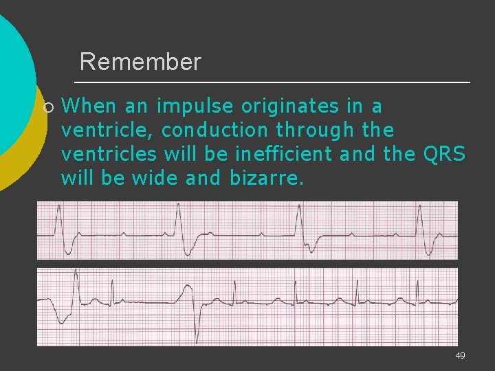 Remember ¡ When an impulse originates in a ventricle, conduction through the ventricles will