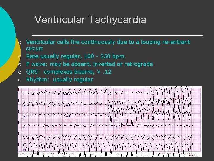 Ventricular Tachycardia ¡ ¡ ¡ Ventricular cells fire continuously due to a looping re-entrant