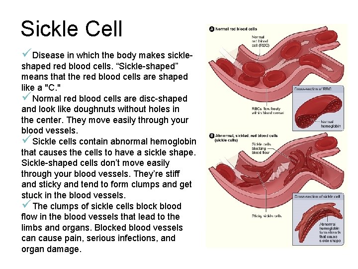 Sickle Cell üDisease in which the body makes sickle- shaped red blood cells. “Sickle-shaped”