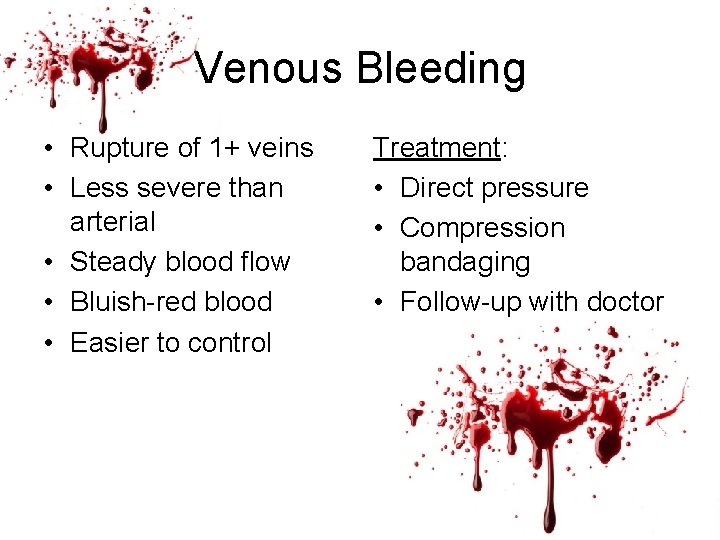 Venous Bleeding • Rupture of 1+ veins • Less severe than arterial • Steady