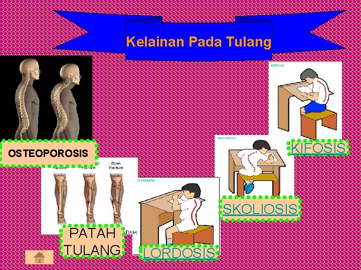 Kelainan Pada Tulang KIFOSIS OSTEOPOROSIS SKOLIOSIS PATAH TULANG LORDOSIS 