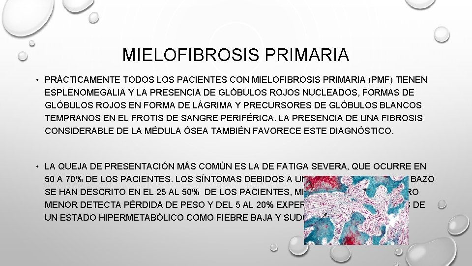 MIELOFIBROSIS PRIMARIA • PRÁCTICAMENTE TODOS LOS PACIENTES CON MIELOFIBROSIS PRIMARIA (PMF) TIENEN ESPLENOMEGALIA Y