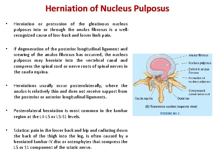 Herniation of Nucleus Pulposus • Herniation or protrusion of the gleatinous nucleus pulposus into